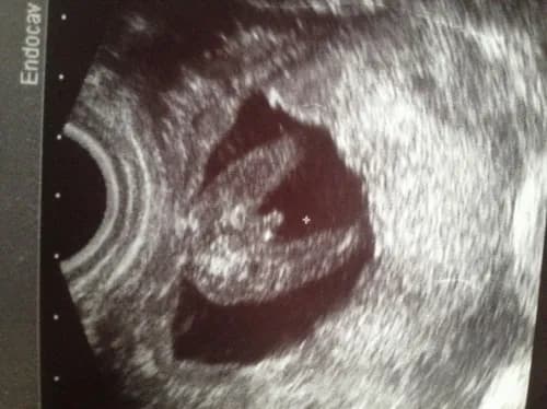 Jak rozpoznać płeć dziecka na usg - co musisz wiedzieć, by nie pomylić