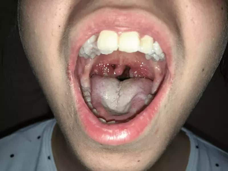 Angina u niemowlaka objawy – jak je rozpoznać i kiedy działać