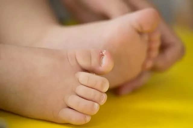 Wrastający paznokieć u niemowlaka: 7 skutecznych metod leczenia