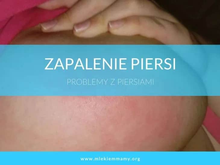 Zapalenie piersi przy karmieniu: skuteczne sposoby leczenia i zapobiegania